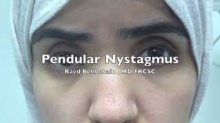 Pendular Nystagmus [upl. by Cyma160]