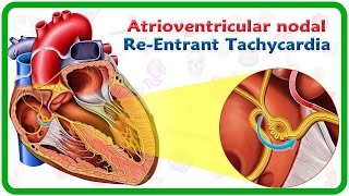 Atrioventricular nodal reentrant tachycardia AVNRT  USMLE [upl. by Voccola935]