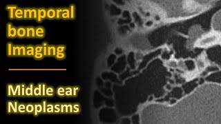 Temporal Bone Imaging  Glomus tympanicum amp other middle ear neoplasms [upl. by Nerhtak775]