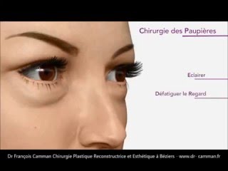 Blépharoplastie Béziers Dr Camman Chirurgien Esthétique [upl. by Pauly]