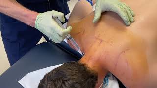 Prolotherapy amp PRP Injections for Neck Pain amp Instability [upl. by Walker884]