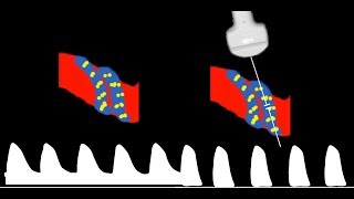 Umbilical Artery Doppler interpretation [upl. by Siocnarf]