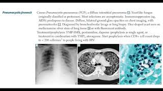 Opportunistic fungal infections Mucor Pneumocystis jirovecii Sporothhrix schenckii6 [upl. by Olaznog]