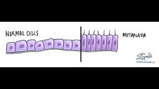 Metaplasia  Explained [upl. by Ahsekat]