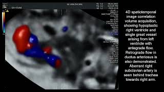 Kleefstra syndrome presenting as pulmonary atresia with intact ventricular septum [upl. by Lozar]