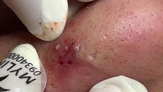 Blackheads Removal  Acne Treatment and Very Satisfying Satisfying Pimple pop blackheads [upl. by Nerwal]