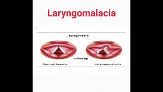 Laryngomalacia mrcpch Recall Communication [upl. by Ezalb576]