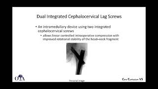 Intertrochanteric femur fractures  3 of 3 [upl. by Aivatnahs204]