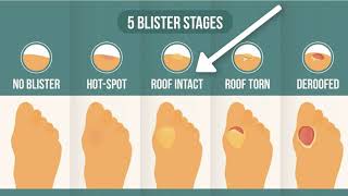 How To Treat A Blister Correctly First Look At Your Blister Roof [upl. by Akinorev]