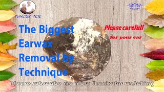 The Biggest Earwax removal by technique 014 [upl. by Cottrell711]