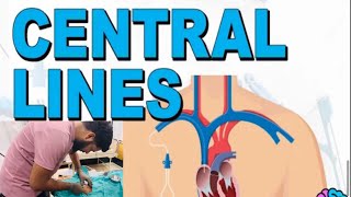 Central line placement  CVP Line  Central Venous Catheter [upl. by Tcideneb66]