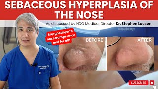 DERMATOLOGIST EXPLAINS HOW TO TREAT NOSE BUMPS DUE TO SEBACEOUS HYPERPLASIA [upl. by Kciredec]