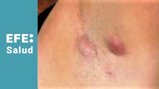 Hidradenitis supurativa abscesos en la piel y mal olor [upl. by Euqinomad]