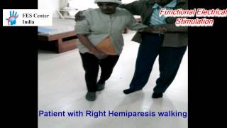 Gait Training with FES System Functional Electrical Stimulation for hemiplegic gait  stroke [upl. by Salter]