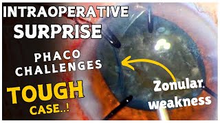 Intraoperative surprises and Phaco challenges in an eye with zonular weakness quotTough Casequot [upl. by Nythsa]