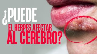 ¿El HERPES puede afectar al CEREBRO ENCEFALITIS HERPÉTICA [upl. by Spears]