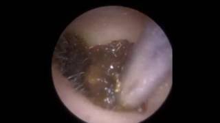 Otoendoscopic Ear Clearance using Suction  Mr Neel Raithatha The Hear Clinic [upl. by Eillime757]