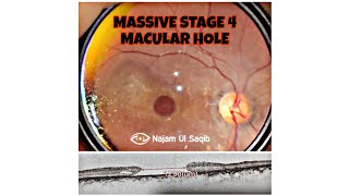 Stage 4 Full Thickness Macular Hole [upl. by Airamasor]