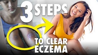 3 EASY Ways to Get Rid of Eczema [upl. by Danete]