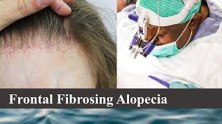 Hair Transplantation in Frontal Fibrosing Alopecia Cases  Bitesize with Bisanga 28  BHR Clinic [upl. by Eigroeg]