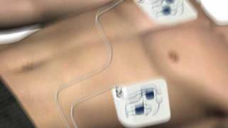 How to use an AED automated external defibrillator [upl. by Nicram]