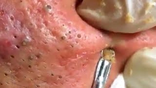 How To Remove Blackheads And Whiteheads On Face Easy 121 ✦ Dr Laelia ✦ [upl. by Iahc]