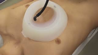 Vacuum Bell for Pectus Excavatum Treatment Therapy Sunken Chest Concave Chest Caved in Chest [upl. by Vastah614]