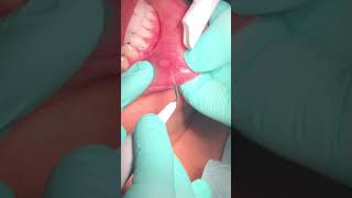 DrYani212 Laser treatment of canker sore [upl. by Ariel375]