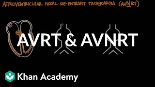 Atrioventricular reentrant tachycardia AVRT amp AV nodal reentrant tachycardia AVNRT [upl. by Willette]