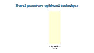 Anesthesia new Neuraxial blocks [upl. by Ettigirb]