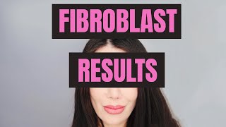 Fibroblast Treatment Results [upl. by Sinegold]