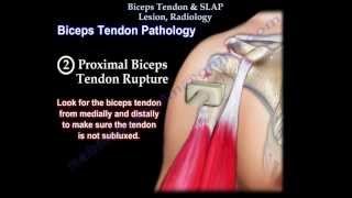 Biceps Tendon amp SLAP Lesion Radiology  Everything You Need To Know  Dr Nabil Ebraheim [upl. by Enilkcaj753]