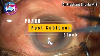 Phacoemusification With Posterior Subtenon Block [upl. by Irab]