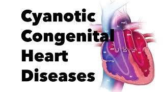 Cyanotic Congenital Heart Diseases  MEDZCOOL [upl. by Alyacim]