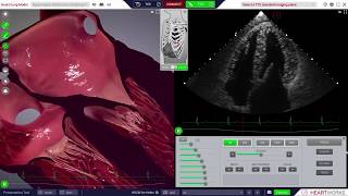 HeartWorks Hypertrophic Cardiomyopathy [upl. by Marabelle]