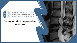 Osteoporotic Compression Fracture [upl. by Etheline662]