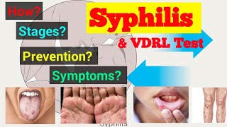 SyphilisVDRL TestSyphilis symptomTPPA testTPHA testSyphilis preventionVDRLSTAR LABORATORY [upl. by Annagroeg211]