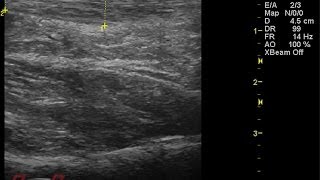 MSK Ultrasound of Plantar Fasciitis [upl. by Osbourn871]