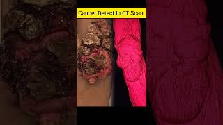 Cancer Detect In CT Scan [upl. by Nnaecyoj157]