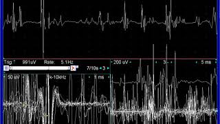 myopathy VM [upl. by Oal10]