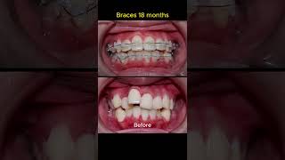 Braces process in 18 months [upl. by Assilrac]