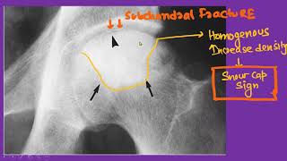 OSTEONECROSIS IMAGING [upl. by Nissie]