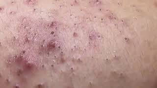 Huge blackhead removal from nose old aged blackheads removal  blackheads new this week 2023 6 [upl. by Jule]