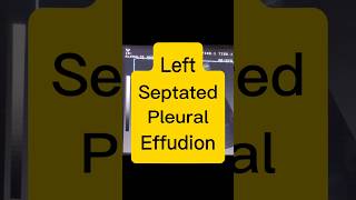 Septated Pleural Effusion  Lung Fluid  Dyspnoea ultrasound [upl. by Odrareg947]