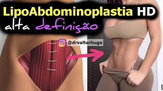 ABDOMINOPLASTIA HD  Definição Abdomen  Antes e Depois e Como é Feita [upl. by Enedan]