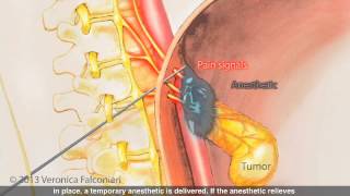 Celiac Plexus Block for Pancreatic Cancer Pain [upl. by Kirst]