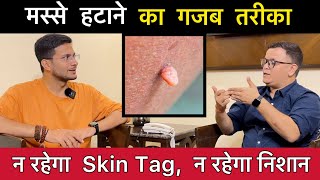 Skin Tags या मस्से हटाने का तरीका  Skin tags removal without surgery  Homeopathy  Himanshu Bhatt [upl. by Etram348]