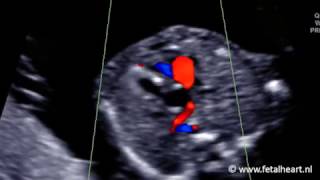 Fetal heart Academy  HLHS AoS 2 Foramen ovale color Doppler [upl. by Nikal]