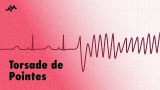 Torsade de Pointes  EKG ECG Interpretation [upl. by Shaer]