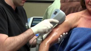 Exilis for Skin Tightening on a Womans Arms with Dr Seiler [upl. by Dunson]